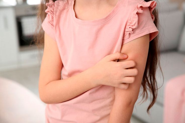 Niña rascándose el brazo por picor de piel atópica